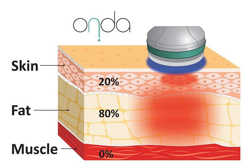 Onda Coolwaves treatments medicine aesthetics dermatology
